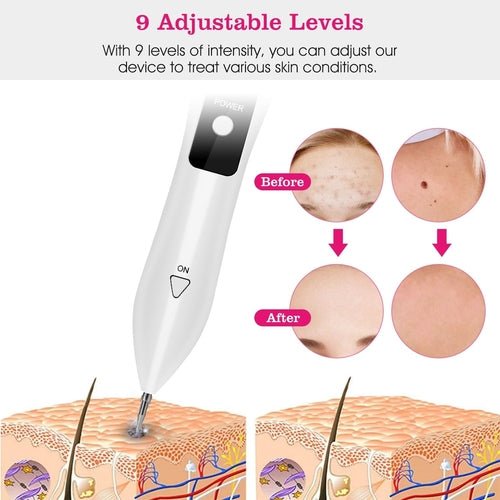 Skin Tag Repair Kit Portable Beauty Equipment Multi - Level with Home - UrbanNest Co